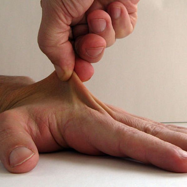 ehlers-danlos-sendromu-1631558660